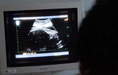 La preeclampsia, síndrome que se presenta en la segunda mitad del embarazo, es responsable del 25 por ciento de las muertes maternas en Chile.