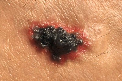 La autoexaminación de la piel es parte del protocolo de prevención de esta patología. 