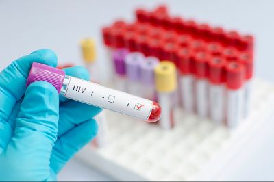 En nuestro país los diagnósticos de VIH tardíos superan el 40 por ciento, lo que ha incidido en la mortalidad de la enfermedad.