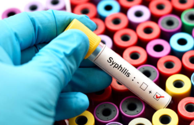 En Chile, el Ministerio de Salud (Minsal) informó el año pasado que más de 35 mil personas han sido diagnosticadas con Sífilis a nivel nacional.