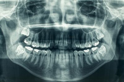 En Chile, el 81 por ciento de los adultos mayores tiene menos de 20 dientes. La enfermedad más frecuente es el daño periodontal y un 57 por ciento tiene caries.