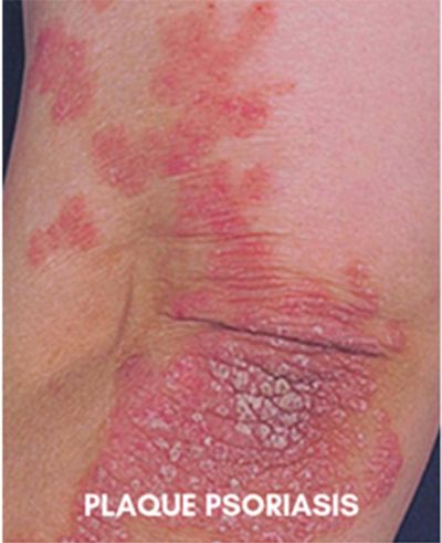 La psoriasis es una enfermedad que afecta a la piel generando manchas escamosas, y que no tiene cura.