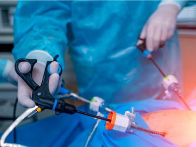 La manga gástrica y el bypass gástrico hoy se realizan mediante la técnica laparoscópica, permitiendo una recuperación mucho más rápida de los pacientes.