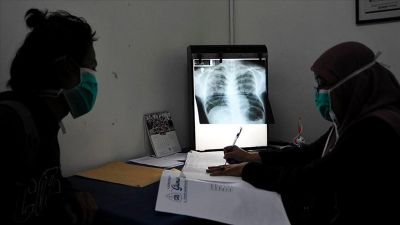 En Chile, durante 2020 hubo más de 2.300 casos notificados de tuberculosis. Debido a la pandemia, los diagnósticos han sido de manera tardía lo que ha generado casos graves de la enfermedad.